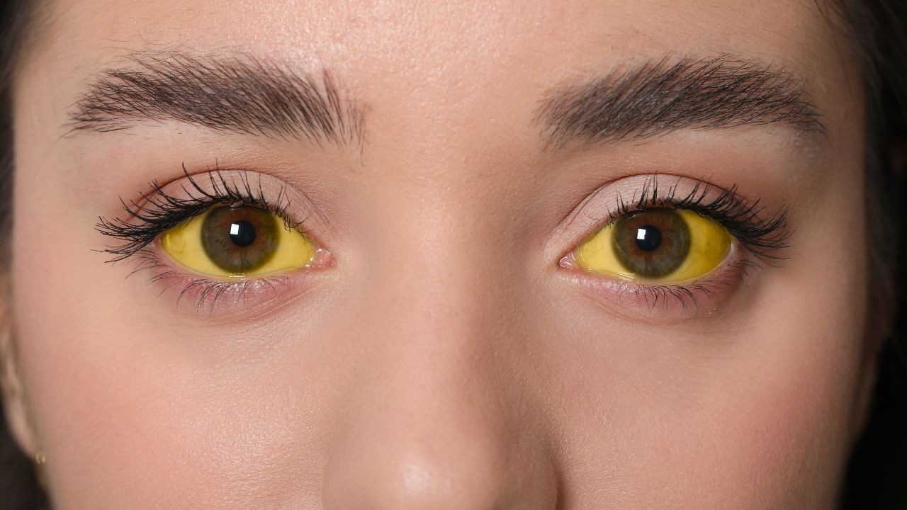 गोहर में पीलिया फैलने का सिलसिला जारी मरीजों की संख्या 68 पहुंची