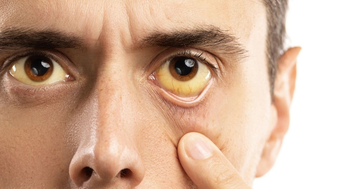 गोहर क्षेत्र में पीलिया का बढ़ता प्रकोप, 234 मामले सामने, दो लोगों की मौत से मचा हड़कंप