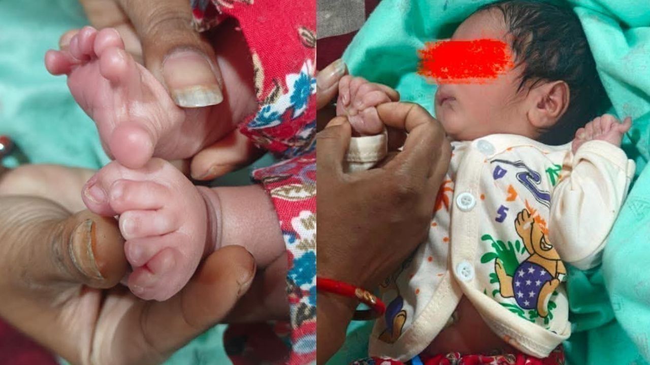 पालमपुर अस्पताल में 24 उंगलियों वाले बच्चे का जन्म, पहला मामला
